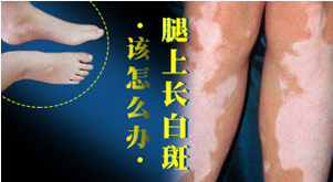 腿部白癜风.png