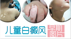 儿童白癜风早期图片.png