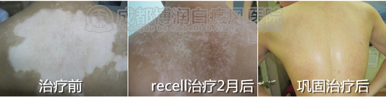 背部白癜风治疗.jpg