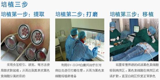 白癜风治疗方法